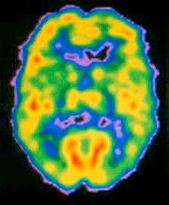 Biomarkers: Can Blood & Brain Scans Help with Future Depression Treatment?